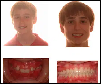 Before and After Case #1 Photo