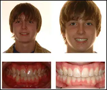 Before and After Case #3 Photo