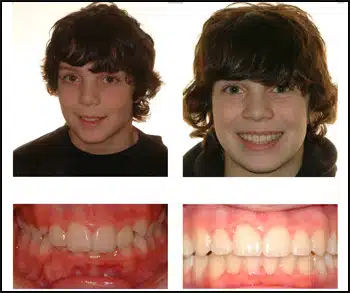 Before and After Case #3 Photo