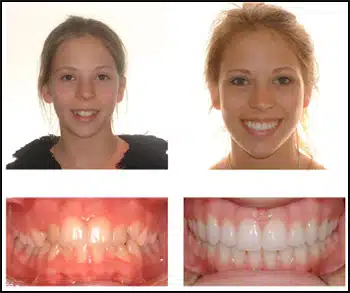 Before and After Case #3 Photo