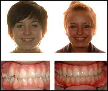 Before and After Case #3 Photo