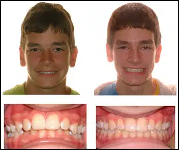 Before and After Case #3 Photo