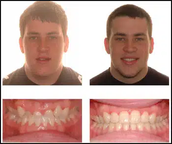 Before and After Case #3 Photo