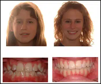 Before and After Case #2 Photo