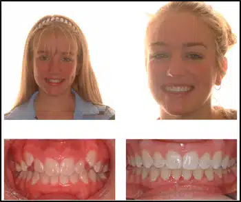 Before and After Case #3 Photo