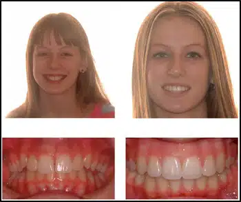 Before and After Case #3 Photo