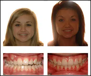 Before and After Case #3 Photo
