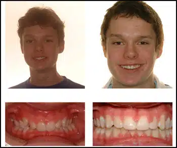 Before and After Case #3 Photo