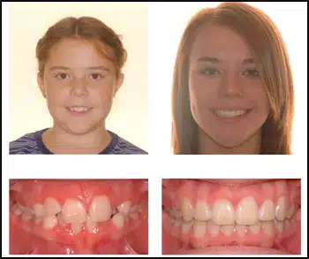 Before and After Case #3 Photo