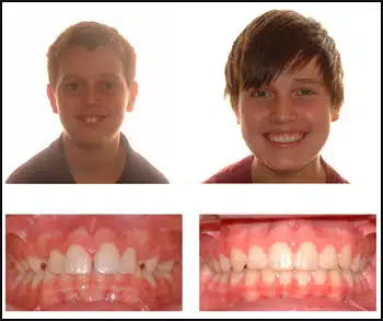 Before and After Case #3 Photo