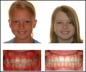 Before and After Case #3 Photo