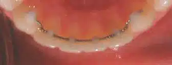 Fixed Orthodontic Retainer