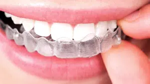 Invisalign Aligners